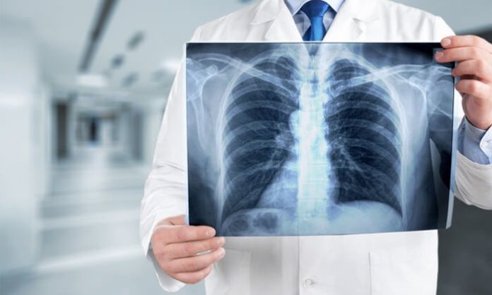 Lung cancer prediction